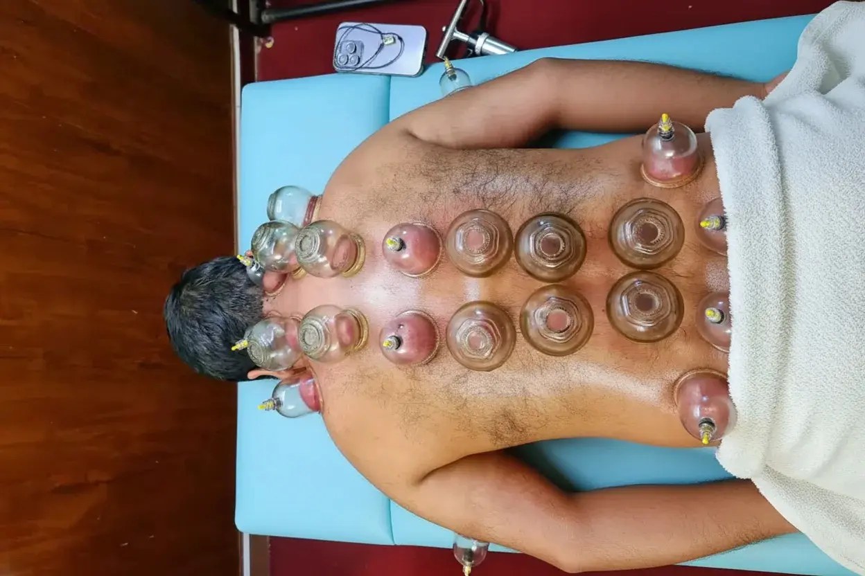 Multiple cups applied during a traditional wet cupping Hijama session on a patient's back