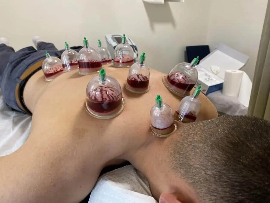 Hijama wet cupping therapy
